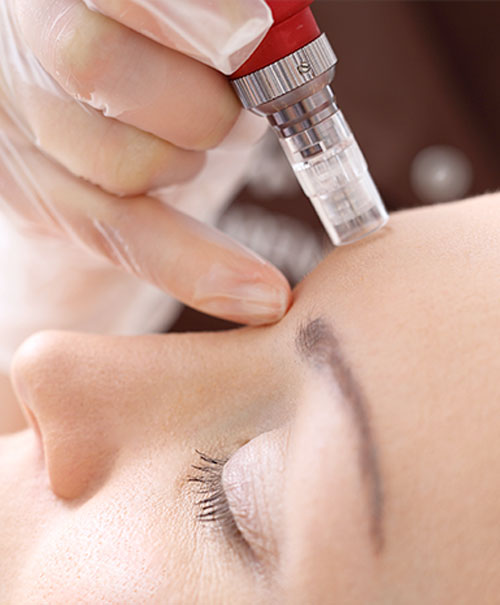 microneedling
