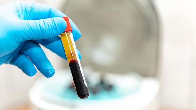 Die 3 Schritte der PRP-Therapie & PRF-Behandlung - Eigenbluttherapie