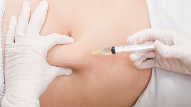 Injektionslipolyse-schritte2