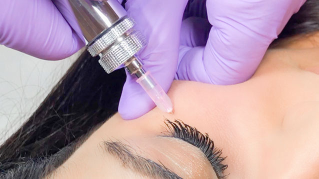 carboxytherapie-schritte2