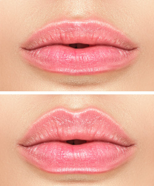 Ästhetik Behandlung Russian-Lips