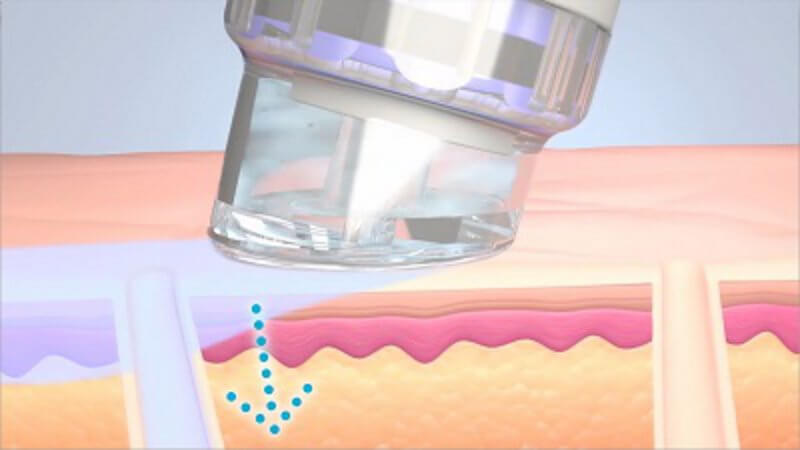 Die vier Schritte einer HydraFacial-Behandlung