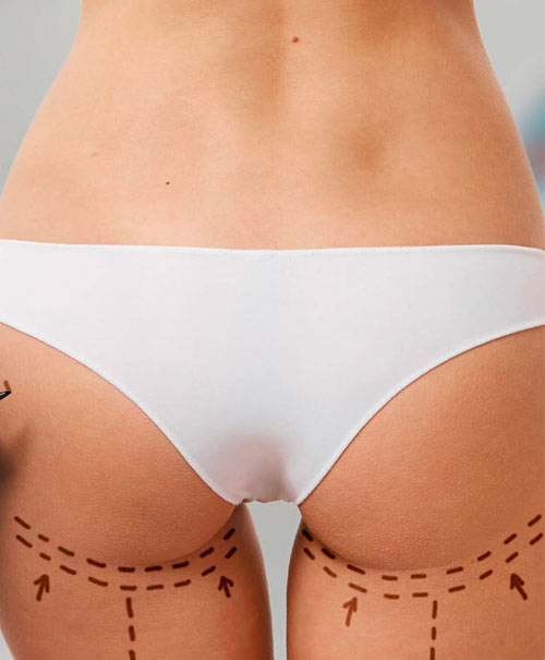 Körper-Behandlungen Po-Vergrößerung mit Sculptra