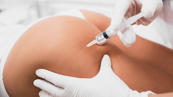 Po-Vergrößerung mit Sculptra Behandlung