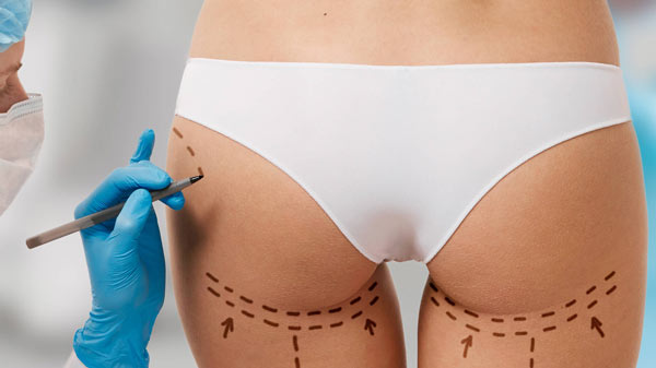 Po-Vergrößerung mit Sculptra Schritte