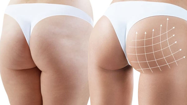 Po-Vergrößerung mit Sculptra Schritte Ergebnis