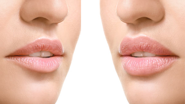 Lip-Flip-Behandlung Frankfurt Schritte