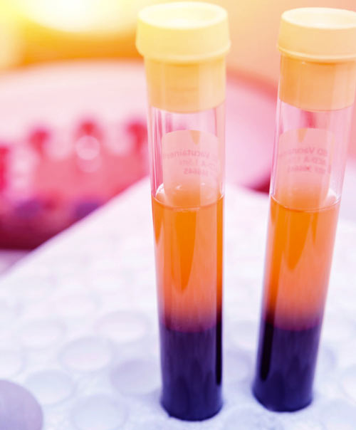 PRF Behandlung - Eigenbluttherapie Übersicht