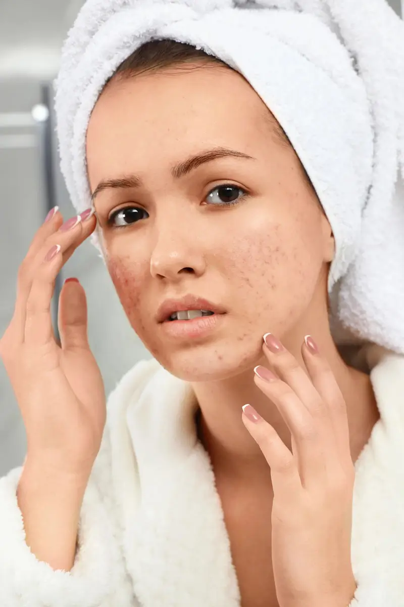 Lasertherapie zur Rosacea-Behandlung im Schönheitszentrum Frankfurt