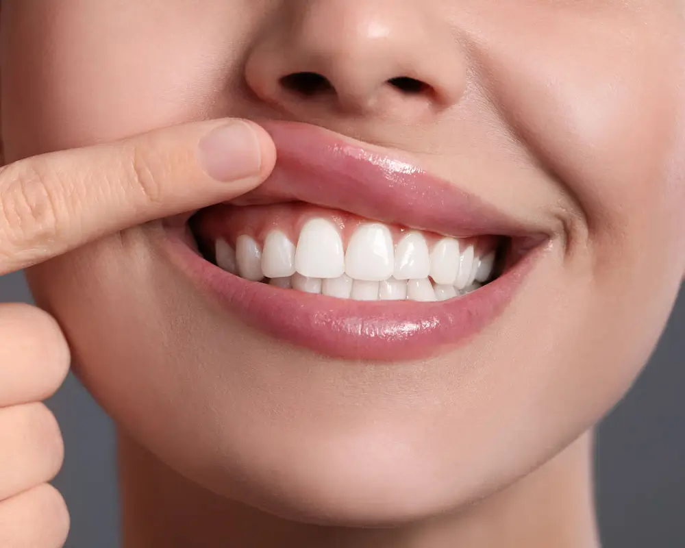 Gummy Smile Behandlung in Frankfurt mit reduziert sichtbarem Zahnfleisch