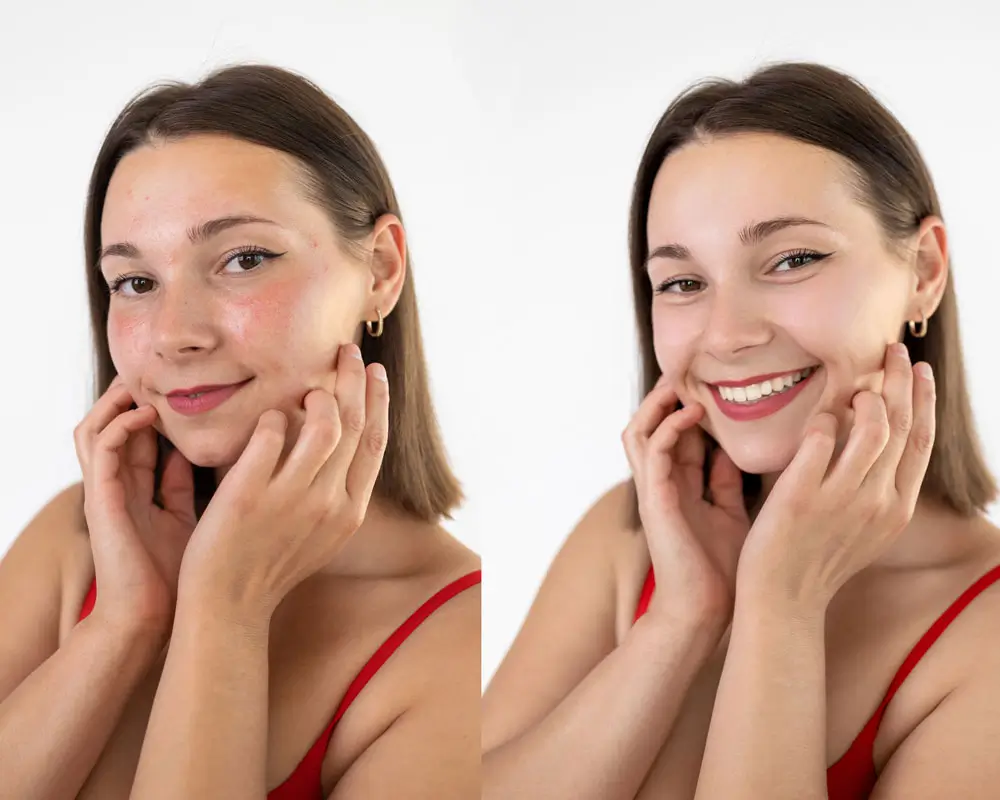 Akne- und Rosacea-Behandlung zur Verbesserung von Hautbild, Rötungen und Unreinheiten