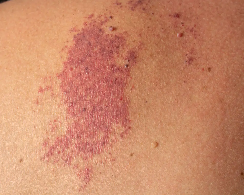 Laserbehandlung von Blutschwämmchen und Feuermalen in Frankfurt zur Reduktion sichtbarer Gefäßveränderungen