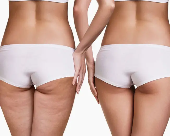 Cellulite Behandlung zur Glättung der Haut und Straffung des Bindegewebes