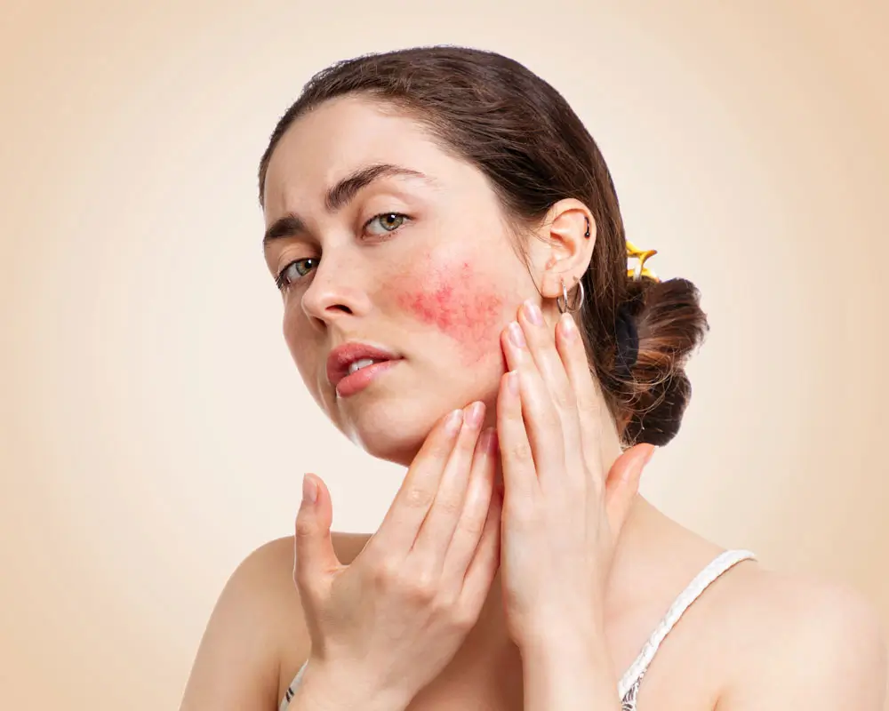 Couperose Laserbehandlung in Frankfurt zur Reduktion von Rötungen und feinen Äderchen im Gesicht