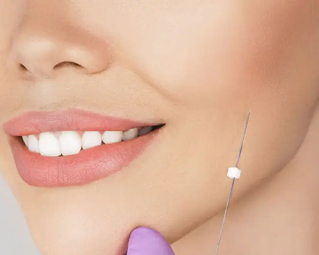 Fadenlifting zur schonenden Hautstraffung und Konturverbesserung ohne Operation