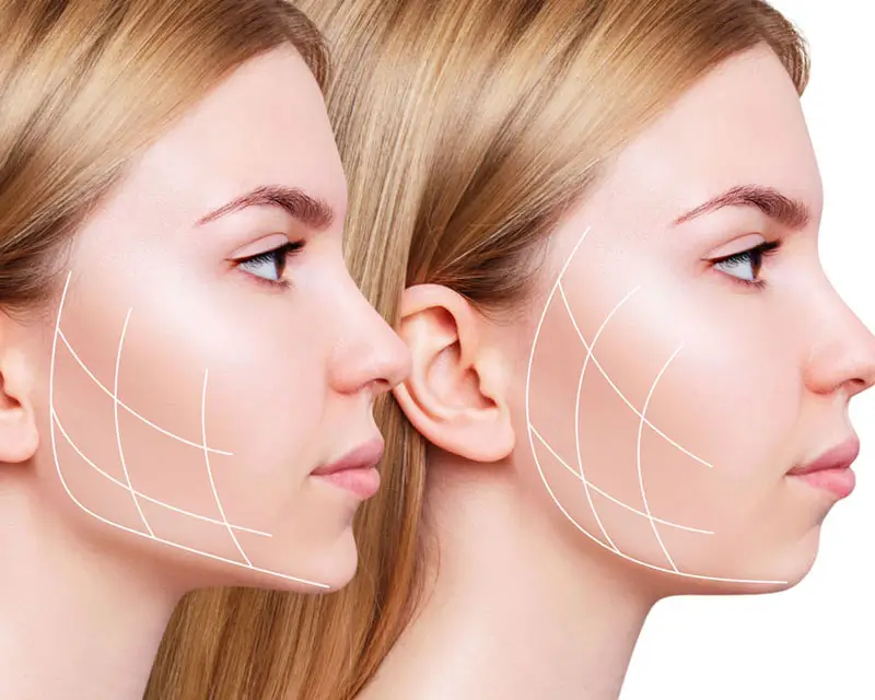 Jawline Behandlung im Schönheitszentrum Frankfurt zur Konturierung von Kiefer und Kinn