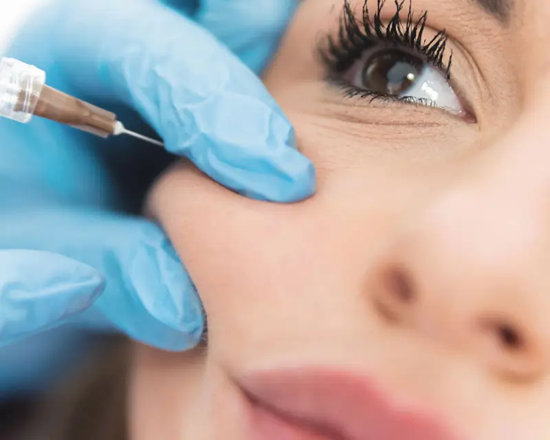 Jochbeinaufbau mit Hyaluron zur Definition der Wangenkontur und Volumenaufbau im Gesicht