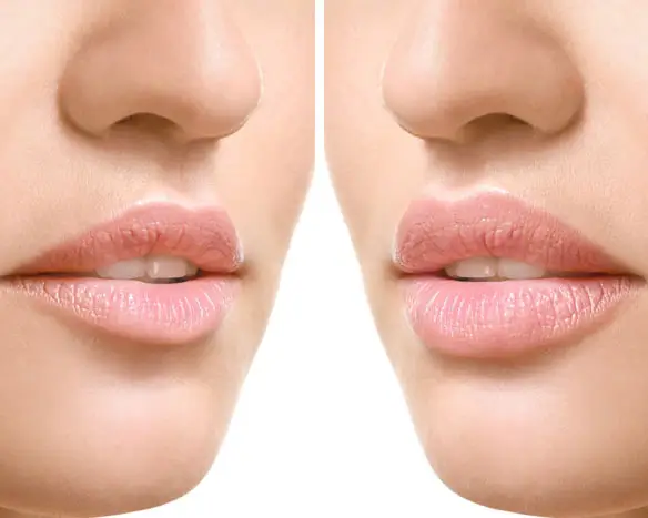 Lip Flip Behandlung im Schönheitszentrum Frankfurt