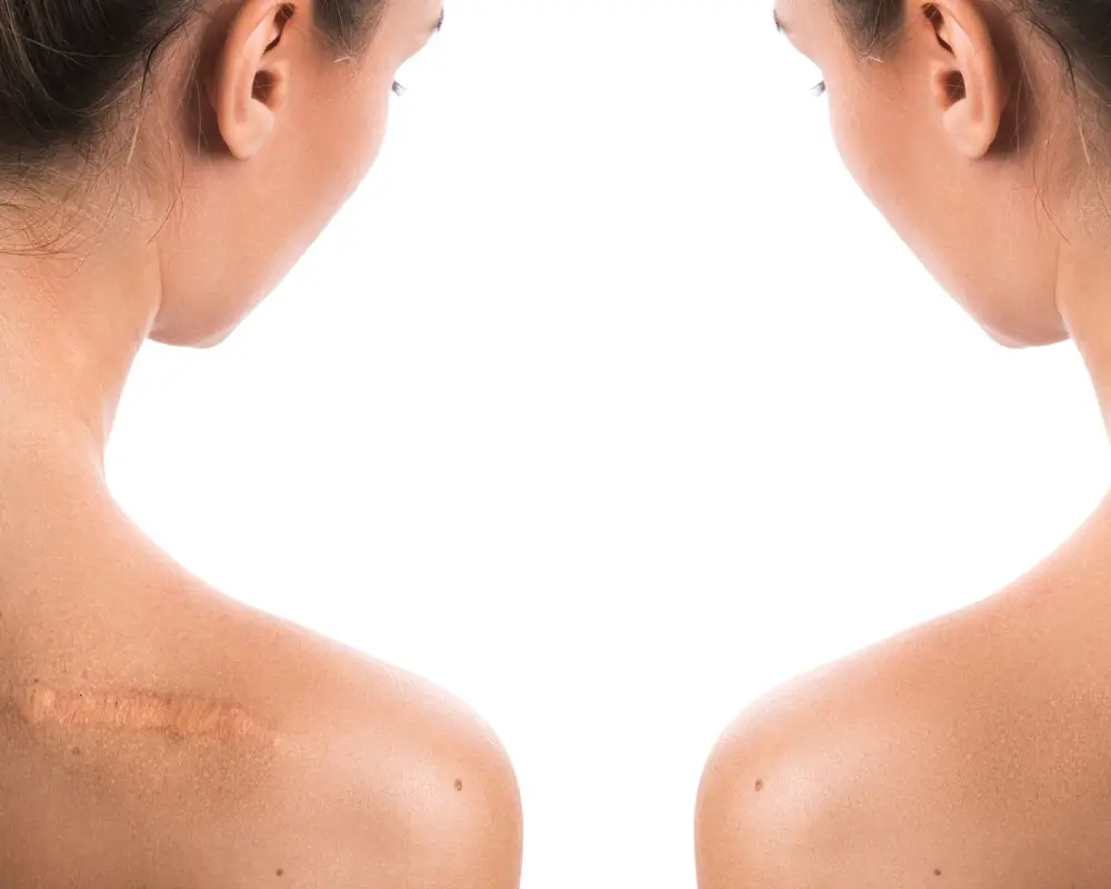 Narbenbehandlung ohne OP zur Verbesserung von Hautstruktur und Narbenbild