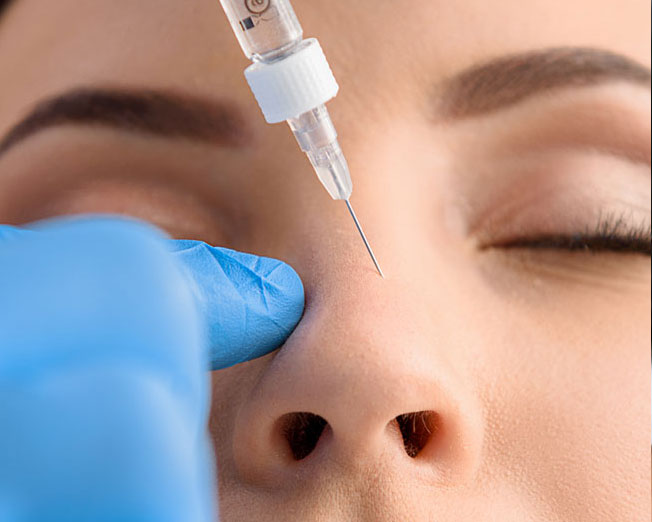 Nasenkorrektur ohne OP in Frankfurt mit Hyaluron zur sanften Modellierung und Harmonisierung der Nase