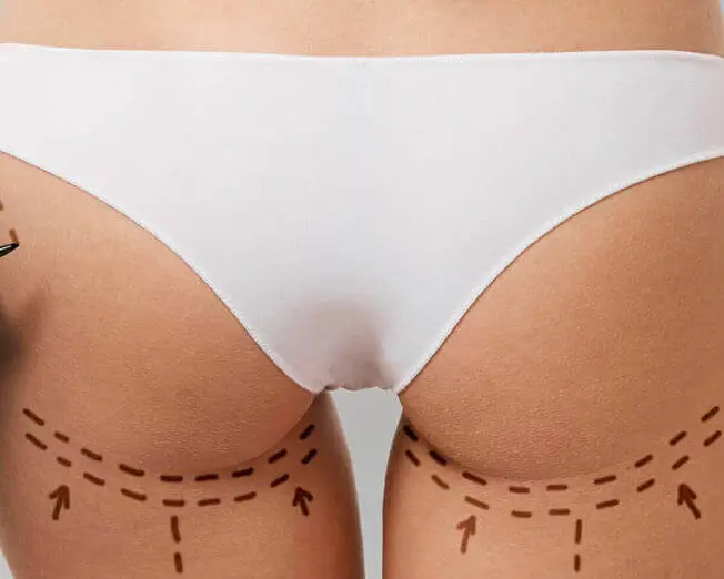 Po Vergrößerung ohne OP mit Sculptra oder Lanluma für natürlichen Volumenaufbau am Gesäß