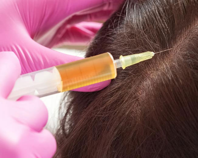 PRP-Haarwachstums-Therapie in Frankfurt zur Behandlung von Haarausfall mit Eigenblut