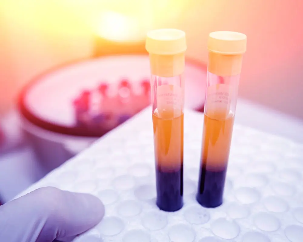 PRP Vampir Lifting in Frankfurt zur natürlichen Hautverjüngung mit Eigenblut - Schönheitszentrum Frankfurt