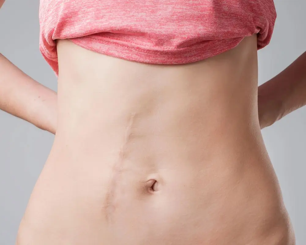 Operative Narbenkorrektur zur chirurgischen Verbesserung sichtbarer Narben