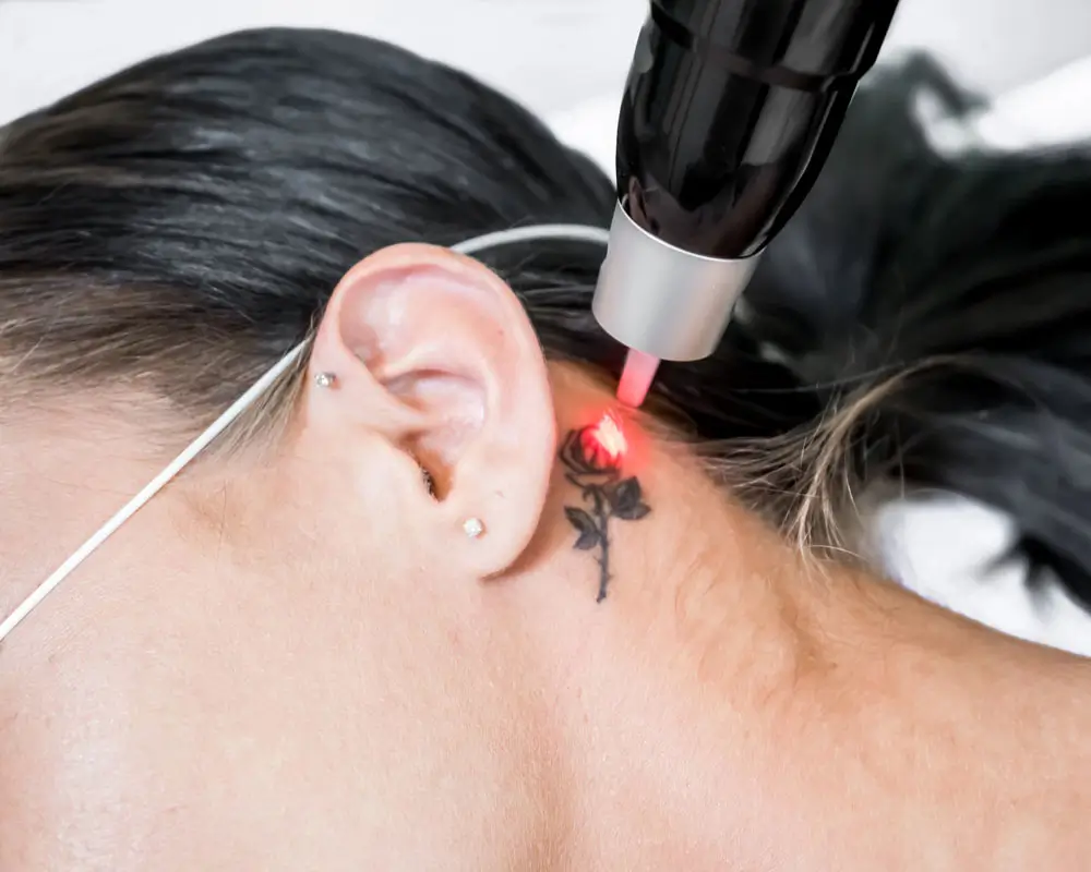 Tattoo-Entfernung in Frankfurt mit Q-Switched-Laser zur schonenden Aufhellung und Entfernung unerwünschter Tattoos