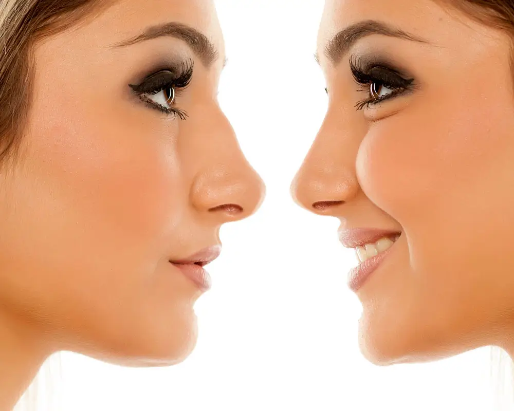 Fadenlifting der Nase in Frankfurt – natürliche Harmonisierung des Nasenprofils ohne Operation